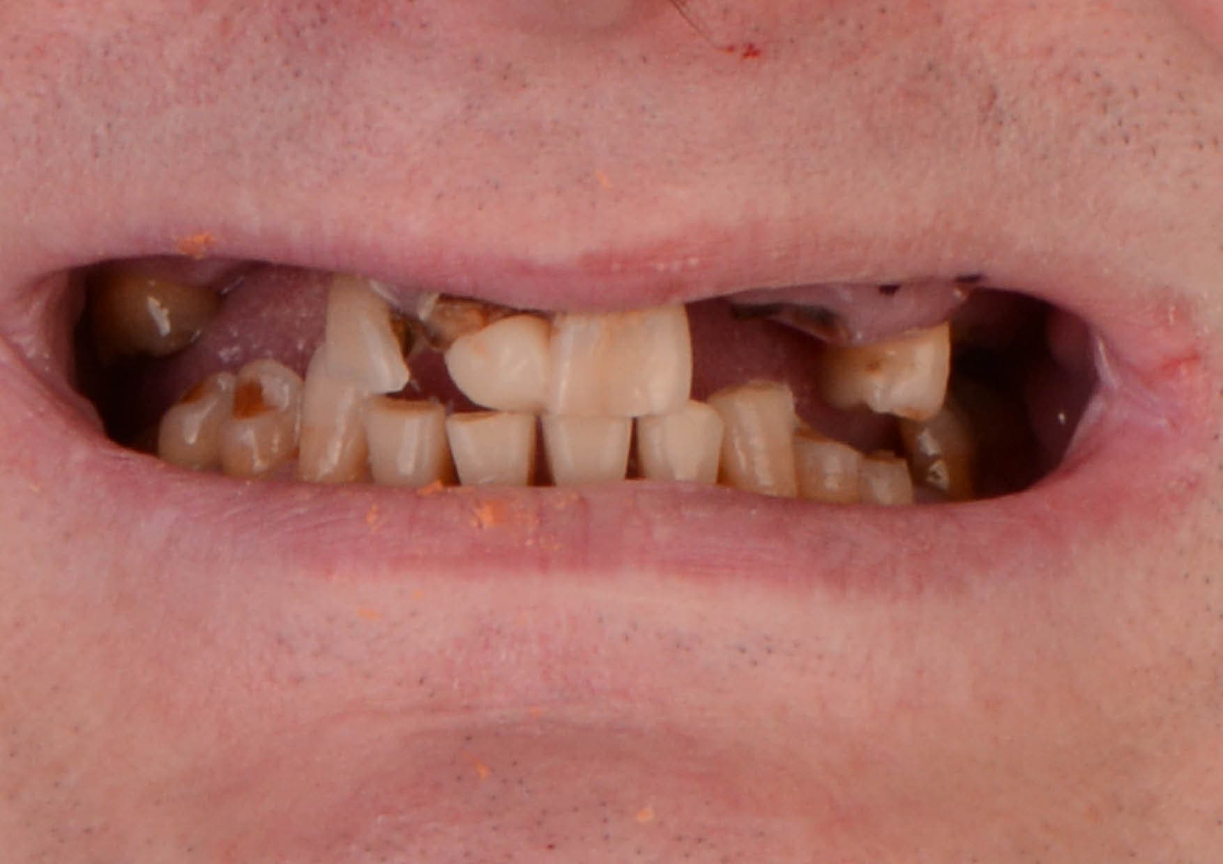 Kompleksowa odbudowa w obu łukach — implanty i bonding — przed leczeniem